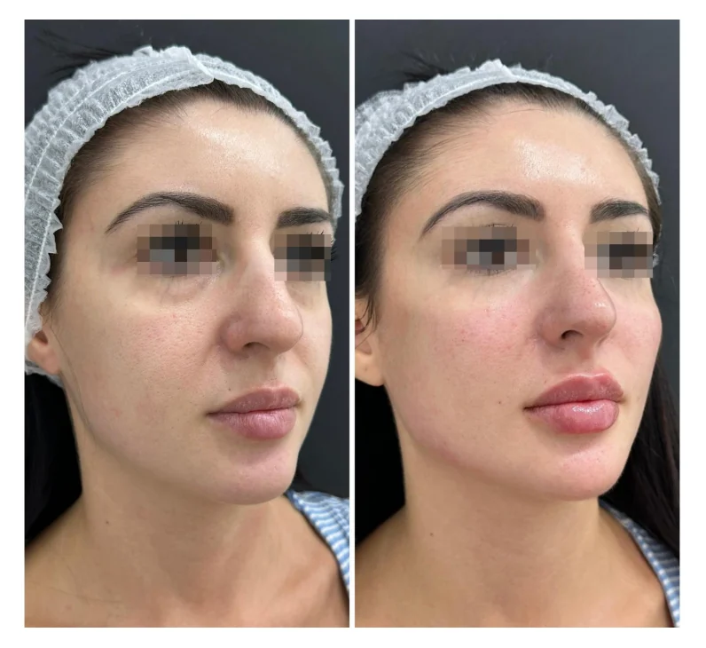 Resultado real de armonización facial, comparación en tres cuartos