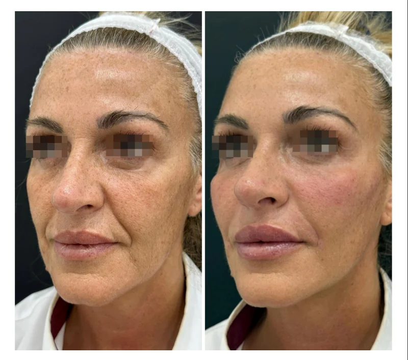 Resultado real de armonización facial en paciente adulta