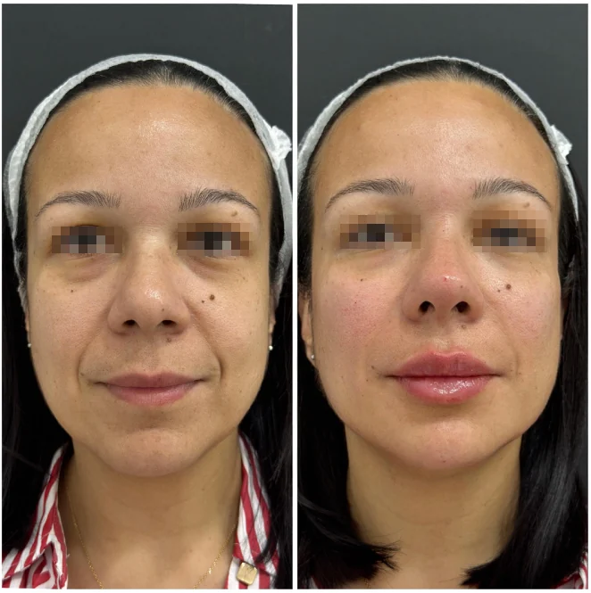 Antes y después de tratamiento de armonización facial