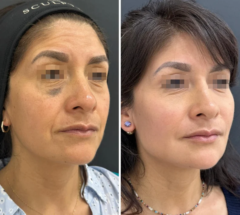Antes y después de tratamiento facial, vista en tres cuartos