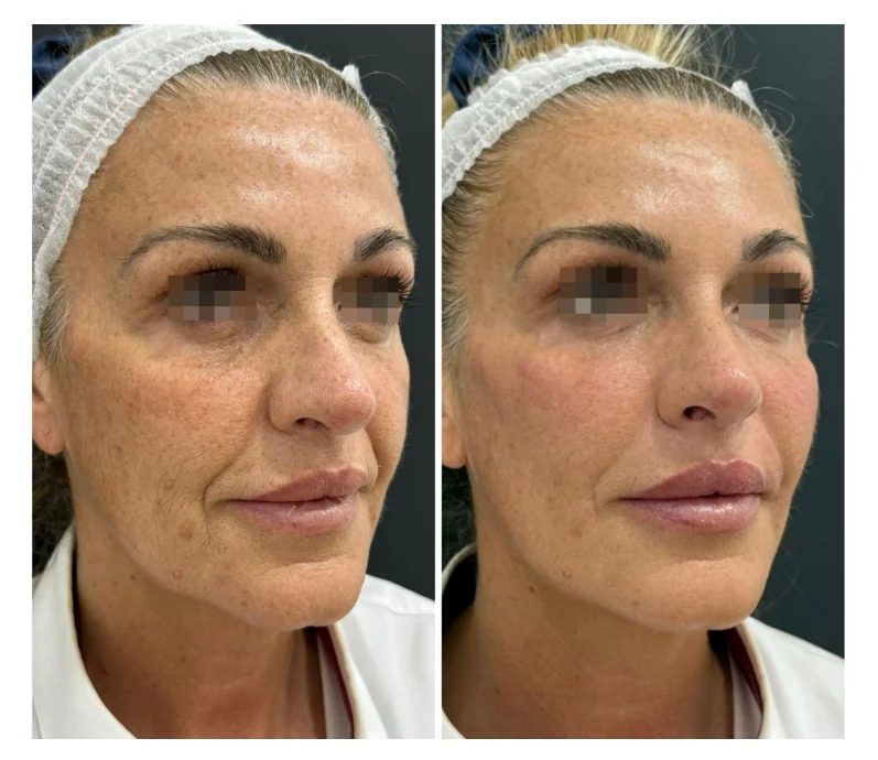Resultado frontal real de armonización facial con identidad protegida
