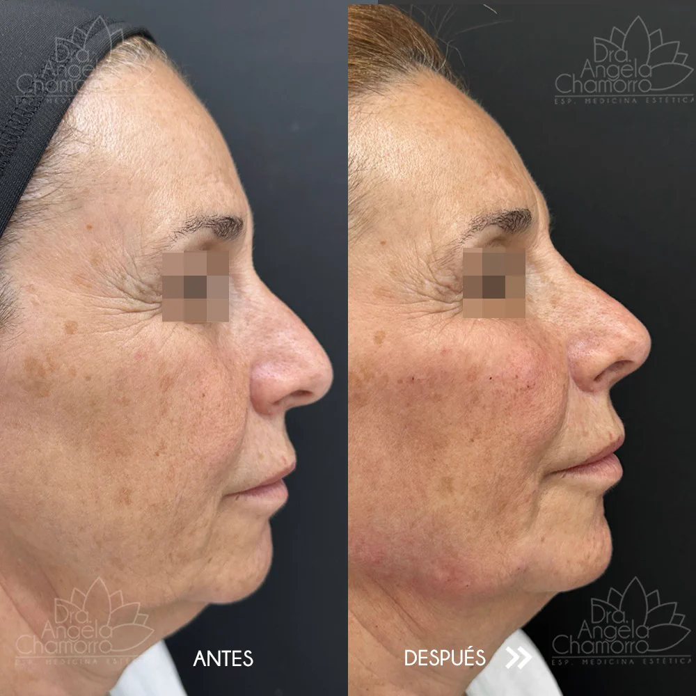 Resultado real de armonización facial de perfil con identidad protegida